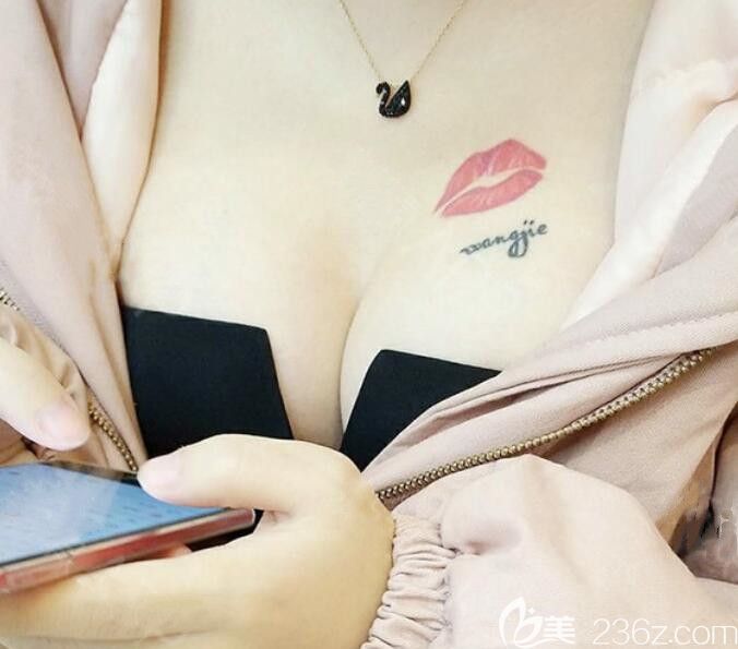 合肥臺(tái)美麗格整形葉凡給我做的隆胸手術(shù)不僅植入了曼托假體還填充了自體脂肪，給大家看下我術(shù)后20天的效果