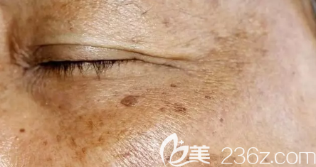 黃褐斑在臉上出現(xiàn)后的圖片 黃褐斑在臉上出現(xiàn)后的圖片