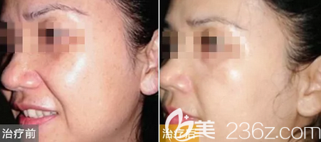 激光祛黃褐斑后的效果圖 激光祛黃褐斑后的效果圖