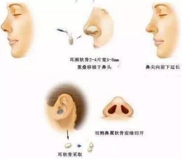 耳軟骨墊鼻尖好不好？會不會被吸收？