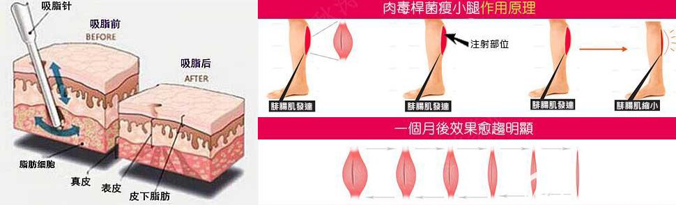 吸脂和瘦腿原理