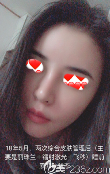 韓國(guó)蕾切爾皮膚管理2次主要麗珠蘭鐳射激光效果真的很好忍不住分享