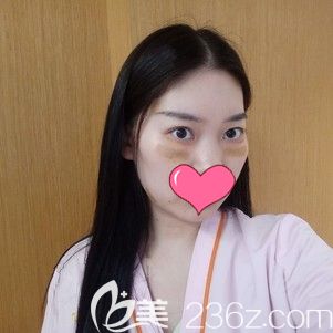楊斐主任幫我做內(nèi)切法去眼袋術(shù)后即刻效果