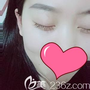 做內(nèi)切去眼袋術(shù)后15天眼袋消失皮膚恢復彈性