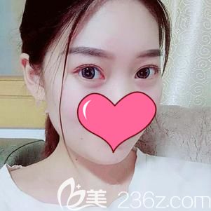 終于把30歲顯老的“罪魁禍?zhǔn)籽鄞钡轿錆h藝星用內(nèi)切法取出了，術(shù)后48天效果感覺還不錯(cuò)