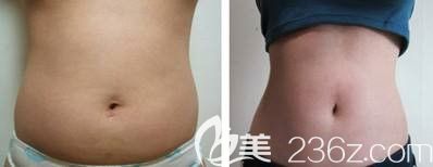 韓國(guó)腰腹環(huán)吸<span style= 韓國(guó)腰腹環(huán)吸<span style=