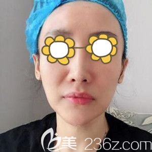 做面部埋線提升術前照 做面部埋線提升術前照