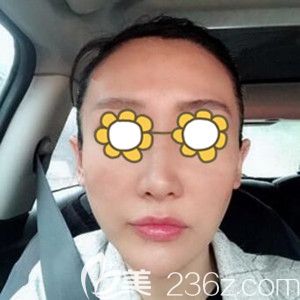 做面部埋線提升術后5天效果圖 做面部埋線提升術后5天效果圖