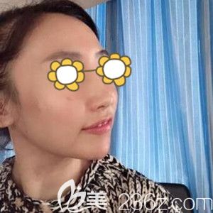 做面部埋線提升術后半個月恢復效果圖 做面部埋線提升術后半個月恢復效果圖