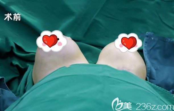 在福州臺江整形取奧美定術(shù)前照 在福州臺江整形取奧美定術(shù)前照