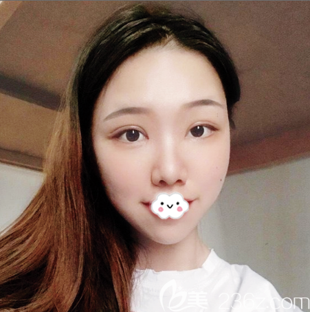 深圳藝星常德成雙眼皮案例7天拆線效果 深圳藝星常德成雙眼皮案例7天拆線效果