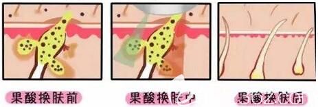 果酸煥膚能夠治療痘痘和痤瘡嗎？