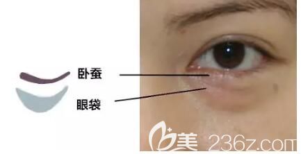 分享臥蠶和眼袋的區(qū)別