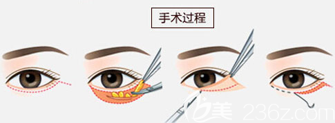 外切法去眼袋手術(shù)原理