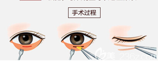 內(nèi)切法去眼袋手術(shù)原理