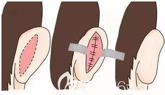 耳朵畸形的手術示意圖