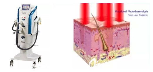 微剝脫性點(diǎn)陣激光去痘印原理