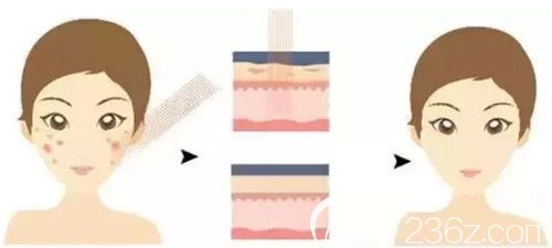 剝脫性點(diǎn)陣激光去痘印