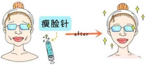 為什么有些人注射瘦臉沒有效果？