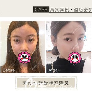 杭州藝星肋軟骨隆鼻<span style= 杭州藝星肋軟骨隆鼻<span style=