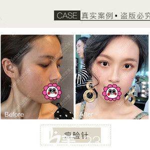 杭州藝星注射瘦臉對(duì)比<span style= 杭州藝星注射瘦臉對(duì)比<span style=