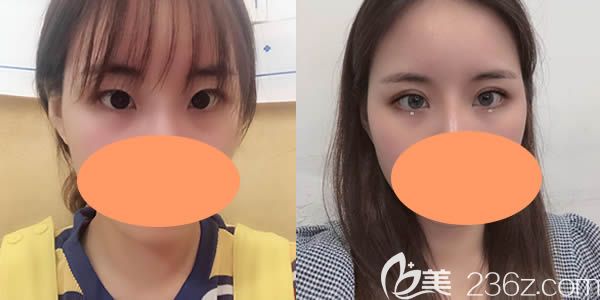 7mm雙眼皮兩個(gè)月后的真實(shí)圖片