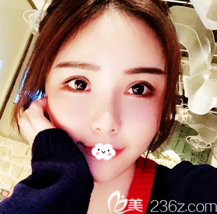 東莞壹加壹朱建生做的面部線雕提升案例