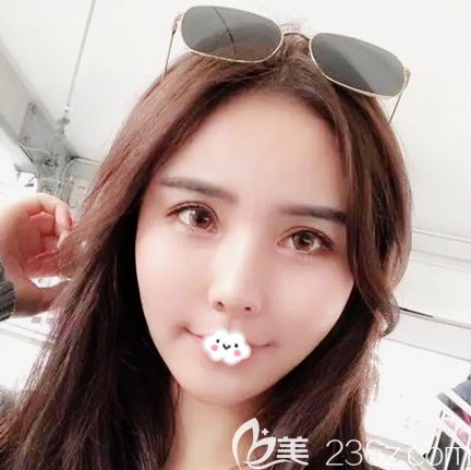 說(shuō)說(shuō)我花一萬(wàn)多元找東莞壹加壹朱建生做面部線雕埋線提升的親身經(jīng)歷和感受