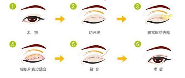 切開(kāi)雙眼皮手術(shù)好不好