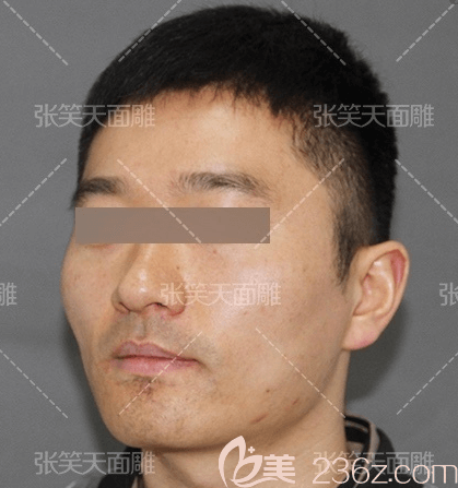 張笑天醫(yī)生給我做顴骨顴弓內(nèi)推＋下頜角前側(cè)面樣子