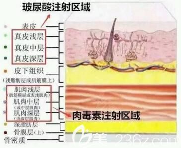 玻尿酸和除皺針的區(qū)別有哪些？
