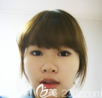韓國愛婷做鼻子怎么樣 韓國愛婷做鼻子怎么樣