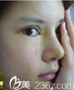 韓國愛婷鼻子雙眼皮脂肪填充顴骨6個(gè)月日記 韓國愛婷鼻子雙眼皮脂肪填充顴骨6個(gè)月日記