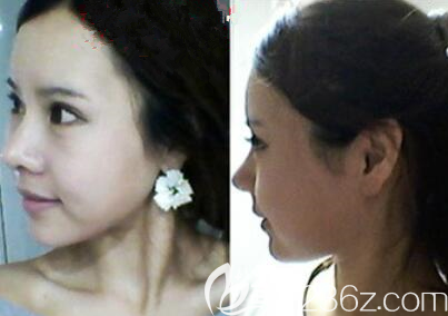 韓國愛婷鼻子雙眼皮脂肪填充真人案例