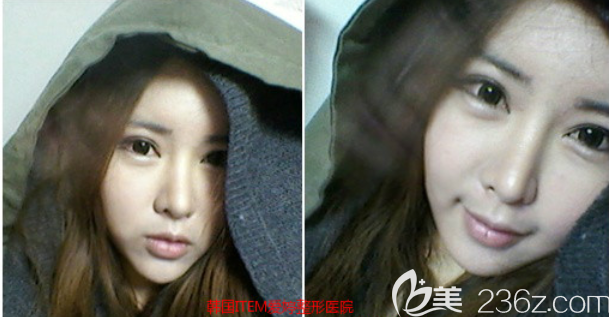 韓國愛婷鼻子雙眼皮脂肪填充顴骨6個(gè)月日記我每天都在炫耀