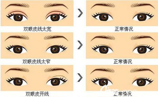 雙眼皮失敗了多久可以修復(fù)