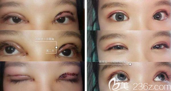 雙眼皮失敗該如何修復(fù)呢