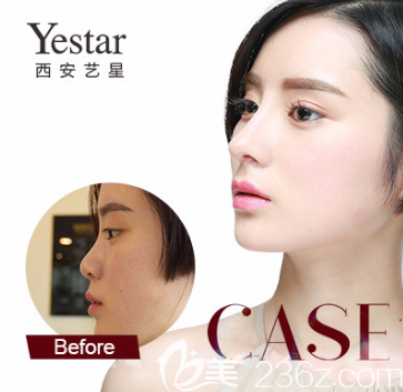 準(zhǔn)備！西安藝星8月份整形價(jià)格表來(lái)襲+鼻綜合只需7777元而已