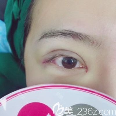 在洛陽毛大夫做眼綜合手術當天 在洛陽毛大夫做眼綜合手術當天