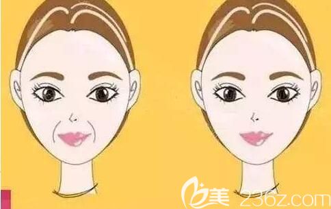 玻尿酸填充消除法令紋