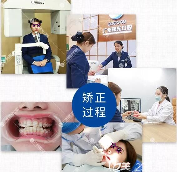 在廣州曙光口腔矯正深覆合前檢查