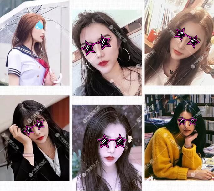 在廣州曙光口腔做了深覆合矯正后像墊下巴，有我深覆合矯正前后臉型對(duì)比圖為證哦