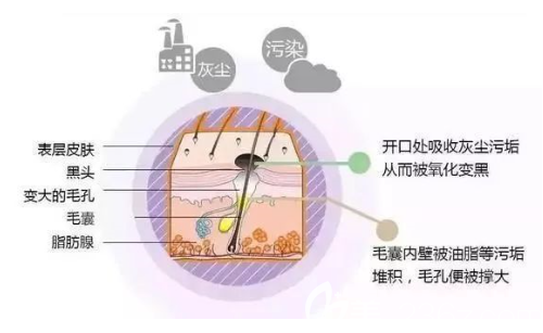 長(zhǎng)黑頭的原因