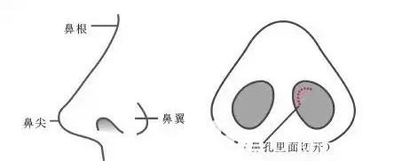 單純隆鼻示意圖