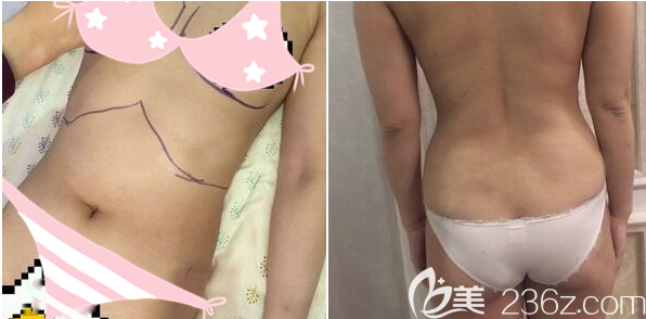 成都軍大整形外科醫(yī)院趙善軍術(shù)前照片1