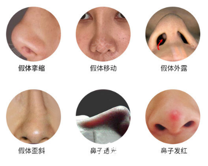 各種二次隆鼻失敗情況