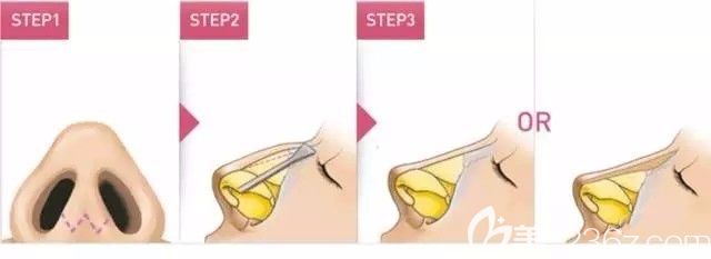 假體植入改善駝峰鼻