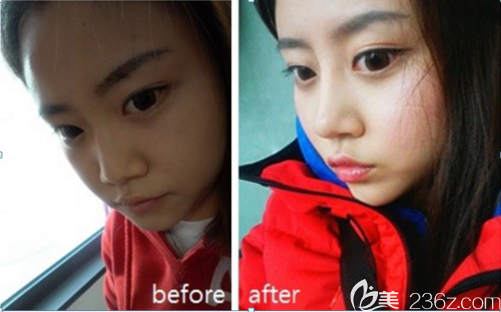 分享我在jk做鼻子的經(jīng)歷比較滿意很自然