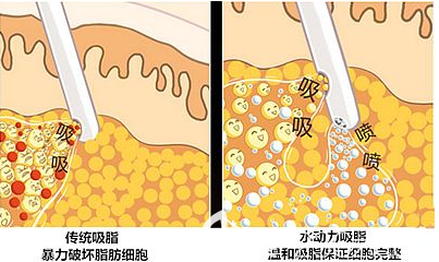 吸脂的手術(shù)示意圖