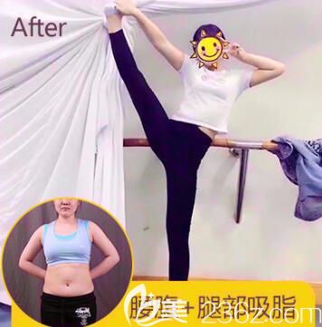 鄭州華領(lǐng)張榮明腰腹吸脂案例